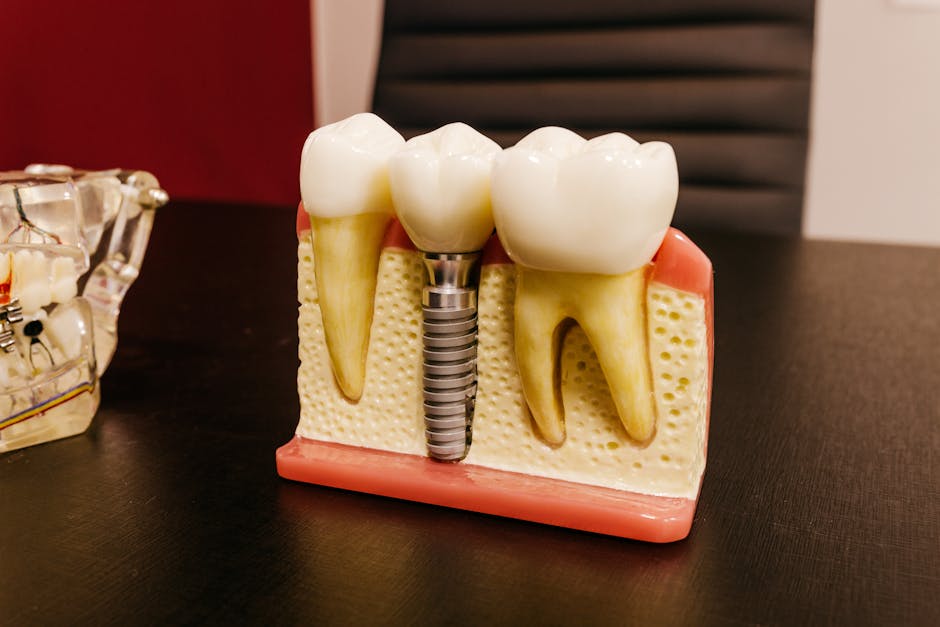 Dental implant diagram - Cosmetic Dentistry