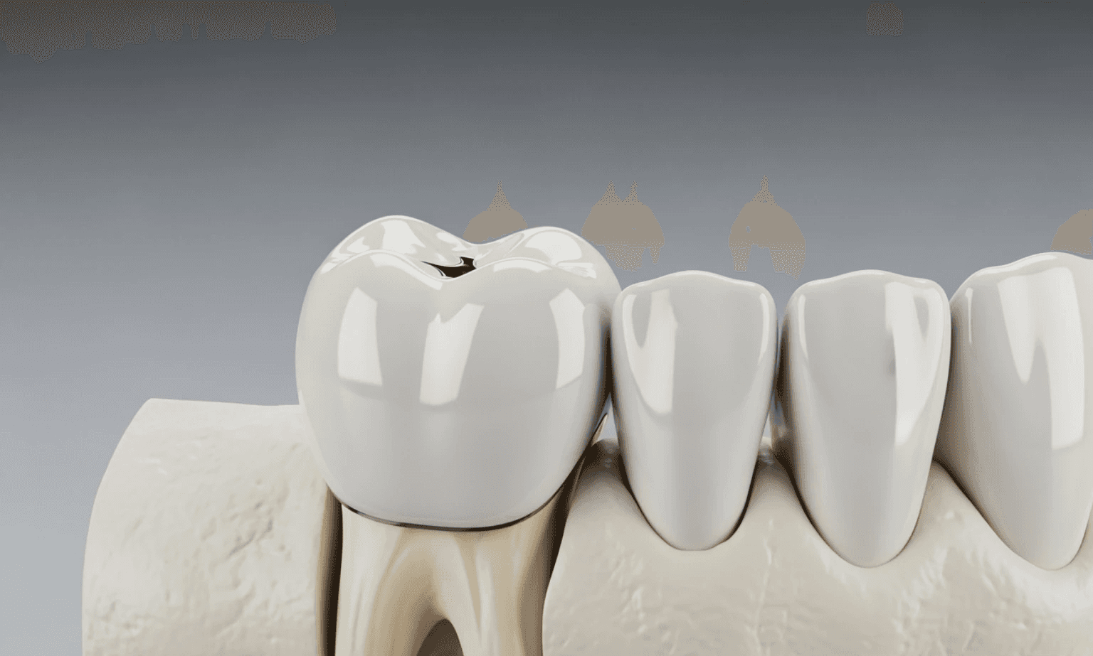 dental crown on a tooth model - Restorative Dentistry Services