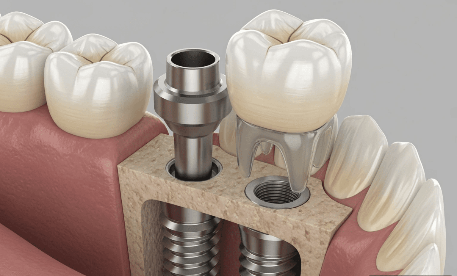 dental implant structure - Restorative Dentistry Services