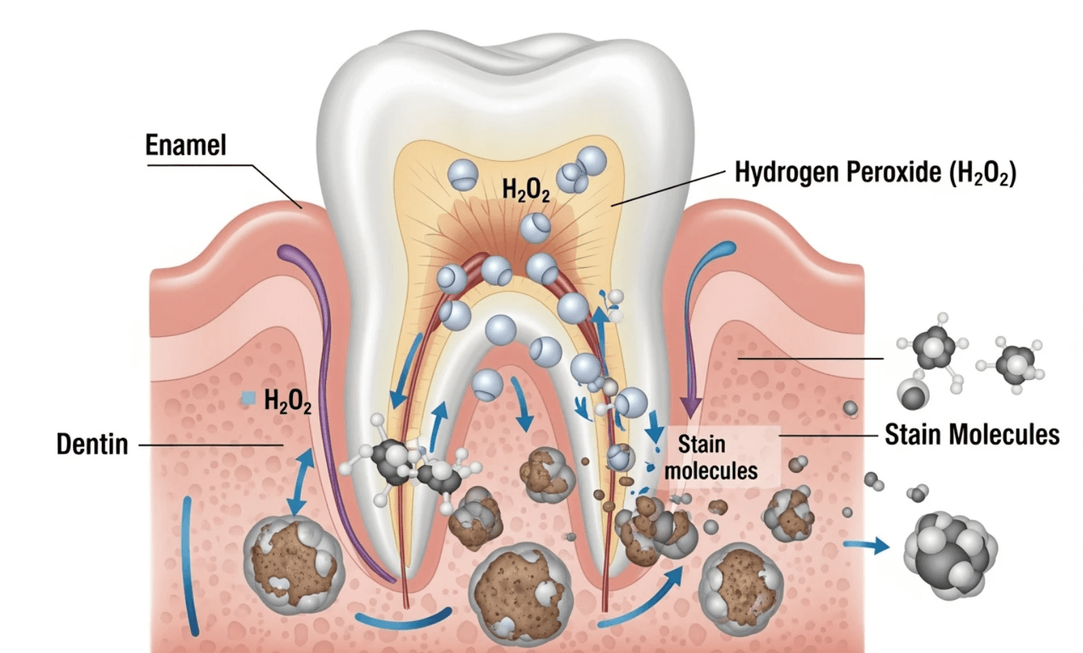 diagram showing hydrogen peroxide molecules penetrating tooth enamel and breaking down stain molecules - Teeth Whitening Methods